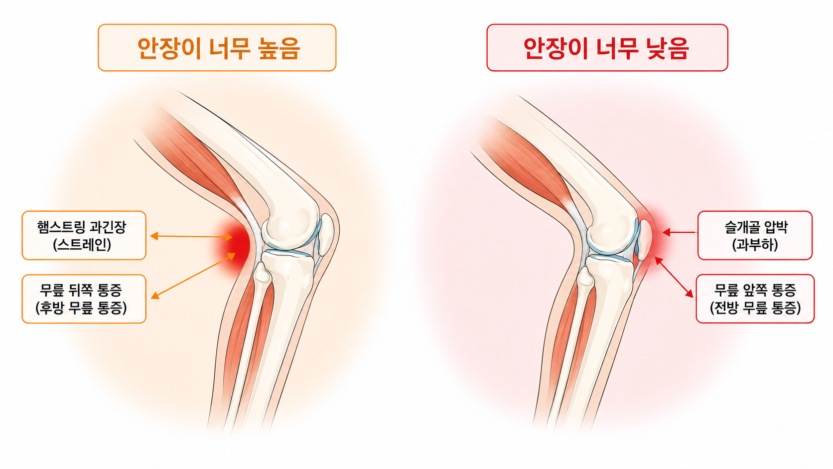 안장 너무 높음/낮음 — 무릎 통증 부위 비교 (햄스트링 과긴장 vs 슬개골 압박)